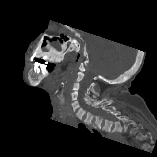 File:Brown tumor with secondary hyperparathyroidism (Radiopaedia 23591-23705 B 3).jpg