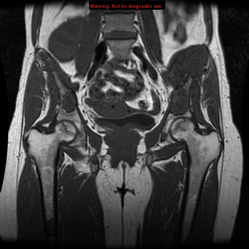 File:Brown tumors (Radiopaedia 9666-10290 Coronal T1 14).jpg