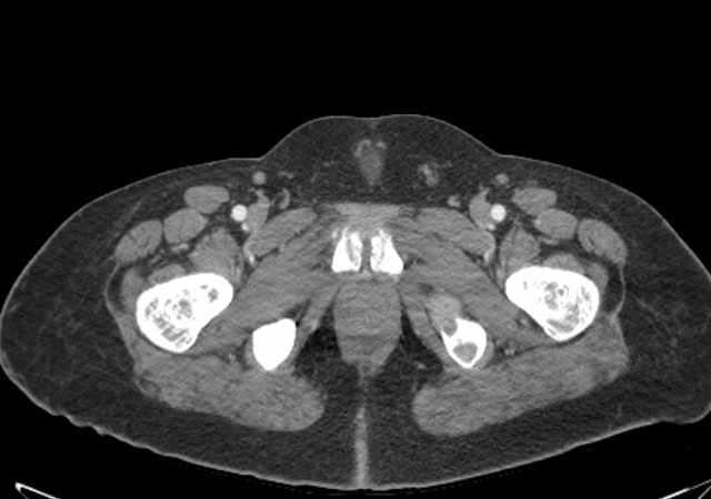 File:Brown tumors compressing the spinal cord (Radiopaedia 68442-77988 E 131).jpg