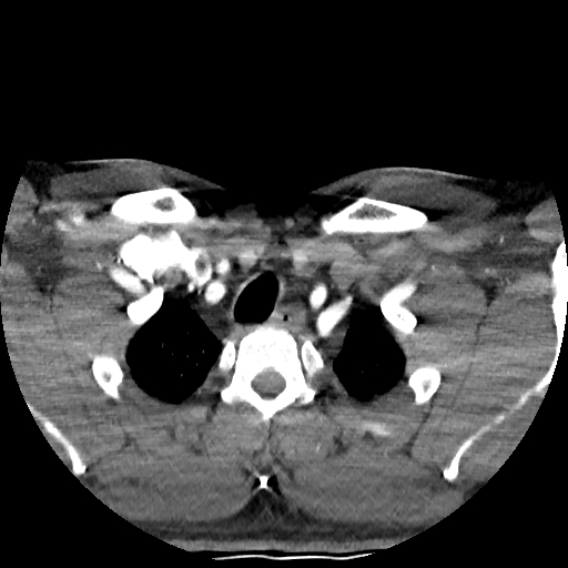 Buccal fat pad arteriovenous malformation (Radiopaedia 70936-81144 D 34).jpg