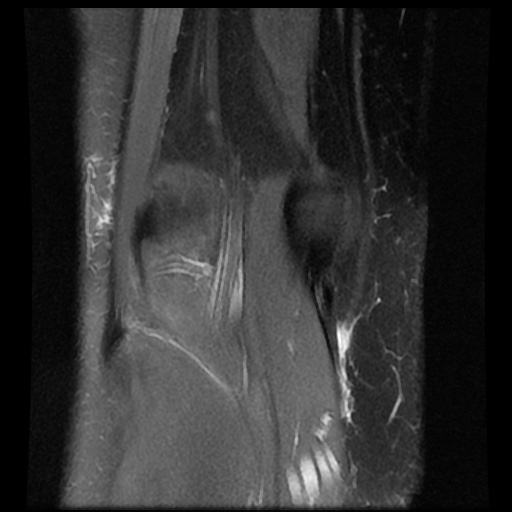 File:Bucket handle meniscus tear (Radiopaedia 56916-63751 Coronal PD fat sat 17).jpg
