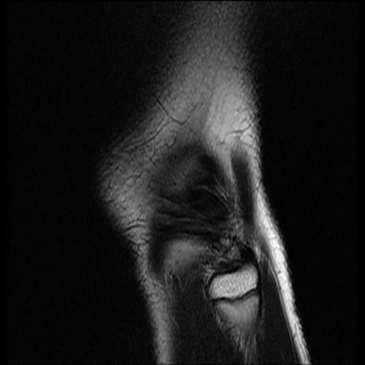 File:Bucket handle tear - lateral meniscus (Radiopaedia 72124-82634 Sagittal T2 1).jpg
