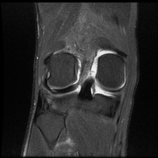 File:Bucket handle tear - medial meniscus (Radiopaedia 69245-79026 Coronal PD fat sat 15).jpg