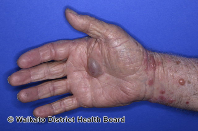 File:Bullous pemphigoid induced by pembrolizumab (DermNet NZ pembrolizumab-pemphigoid-03).jpg