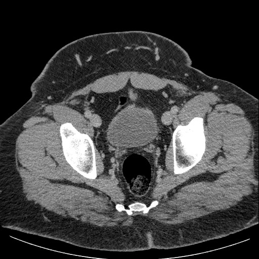 Burned-out testicular seminoma - retroperitoneal nodal metastases (Radiopaedia 62872-71245 A 65).jpg