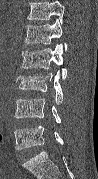 Burst fracture (Radiopaedia 53373-59357 Sagittal bone window 47).jpg