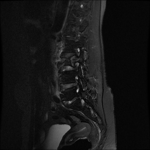 File:Burst fracture - lumbar spine (Radiopaedia 72877-83541 Sagittal STIR 8).jpg