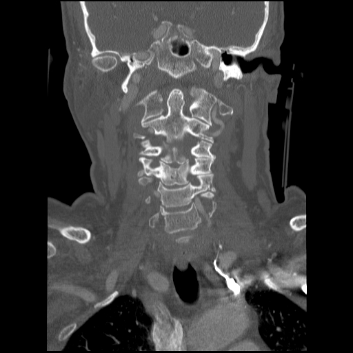 C1 anterior arch (plough) fracture - type 1 (Radiopaedia 76181-87720 Coronal bone window 55).jpg