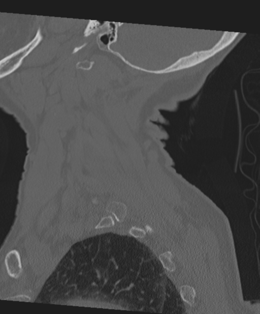 C2 fracture with vertebral artery dissection (Radiopaedia 37378-39199 Sagittal bone window 17).png