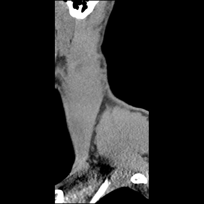 C5 facet fracture (Radiopaedia 58374-65499 D 67).jpg