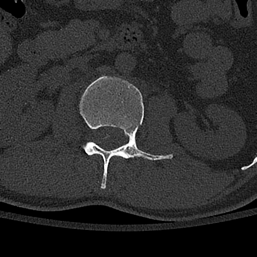 Calcaneal fractures with associated L2 burst fracture (Radiopaedia 71671-82493 Axial bone window 42).jpg