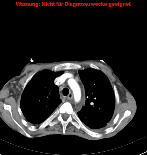 File:Calcific constrictive pericarditis (Radiopaedia 24701-24967 A 1).jpg