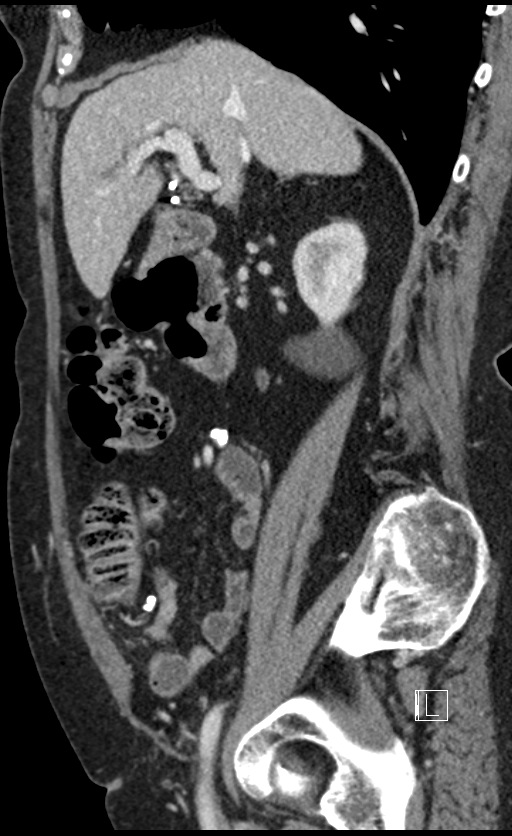 Calcified adrenal glands and Spigelian hernia (Radiopaedia 49741-54988 C 107).jpg
