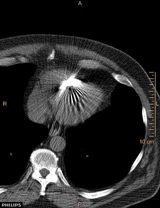 File:Calcified cardiac fibroma (Radiopaedia 39267-41519 Axial non-contrast 11).jpg