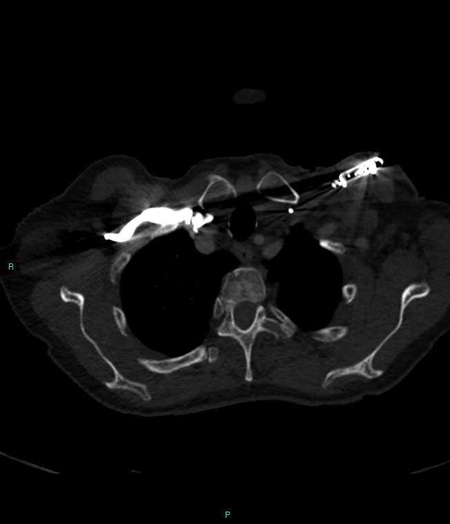 Calcified cerebral emboli from left ventricular thrombus (Radiopaedia 84420-99760 Axial bone window 10).jpg