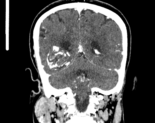 Calcified cerebral hydatid cyst (Radiopaedia 65603-74717 C 51).jpg