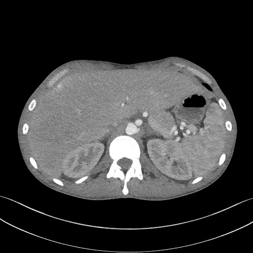 Cannonball metastases - testicular choriocarcinoma (Radiopaedia 84510-99891 B 107).jpg