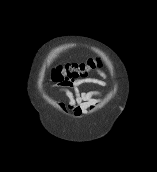 File:Cannonball metastases from endometrial cancer (Radiopaedia 42003-45031 F 8).png