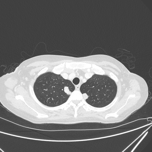 Canonball lung metastasis (Radiopaedia 77634-89837 Axial lung window 32).jpg