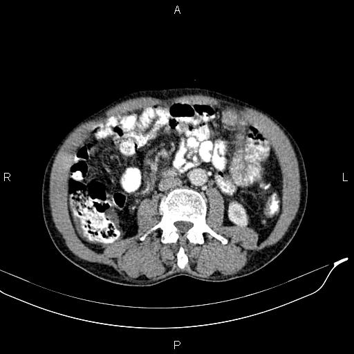 File:Caput medusae sign - portal hypertension (Radiopaedia 64007-72759 A 50).jpg