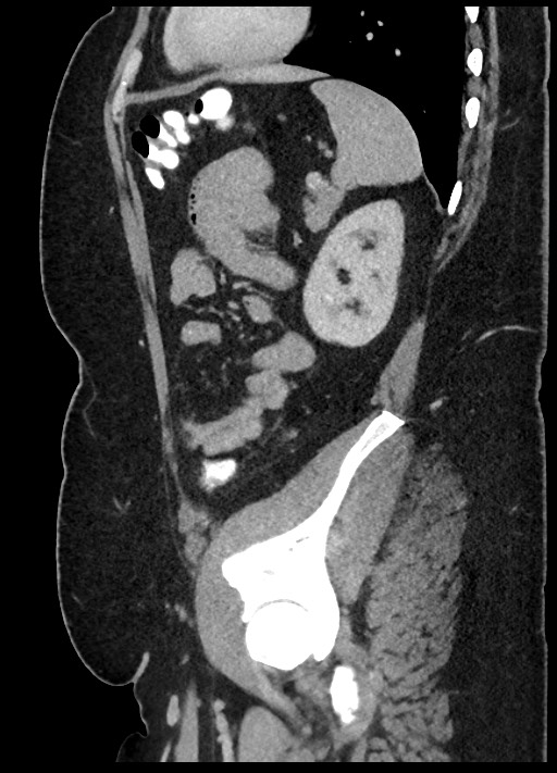 Carcinoid tumor - terminal ileum (Radiopaedia 60931-68739 C 20).jpg
