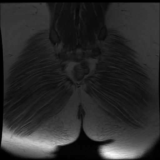 File:Carcinoma of the cervix (Radiopaedia 89018-105858 Coronal T1 18).jpg