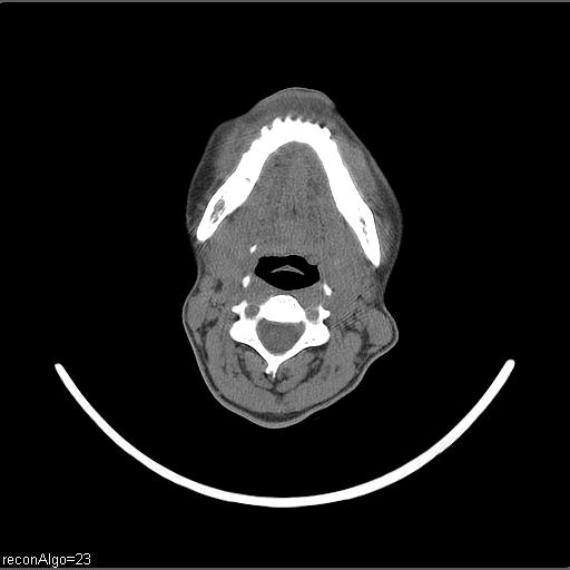 Carcinoma of the maxillary antrum (Radiopaedia 53805-59888 Axial non-contrast 39).jpg
