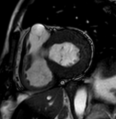 Cardiac amyloidosis - ATTR wild-type (Radiopaedia 74412-85296 short axis cine SSFP 137).jpg
