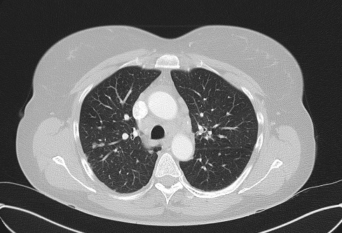 Cardiac sarcoidosis (Radiopaedia 74548-85534 Axial lung window 28).jpg