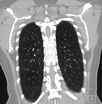 Cardiac sarcoidosis (Radiopaedia 74548-85534 Coronal lung window 57).jpg