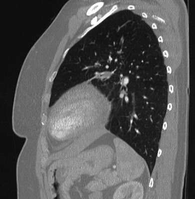 File:Cardiac sarcoidosis (Radiopaedia 74548-85534 Sagittal lung window 26).jpg