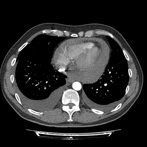 Cardiac tamponade (Radiopaedia 78607-91368 Axial C+ CTPA 65).jpg