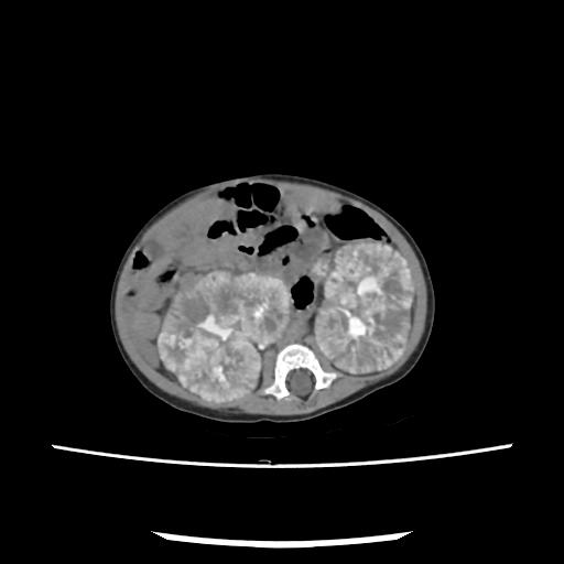 File:Caroli disease with autosomal recessive polycystic kidney disease (ARPKD) (Radiopaedia 89651-106703 E 130).jpg