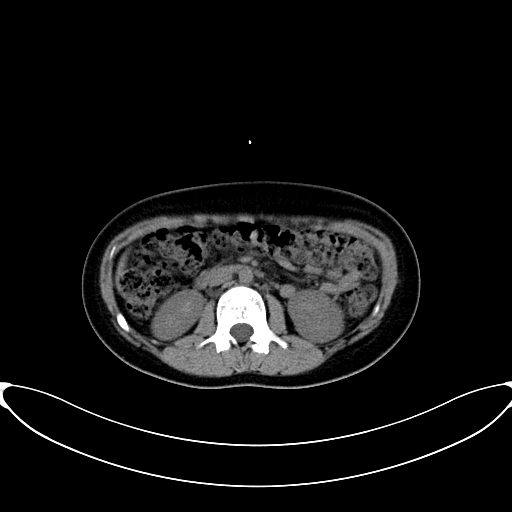 Caroli disease with medullary sponge kidney (Radiopaedia 82622-96804 Axial non-contrast 32).jpg