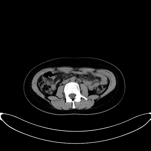 Caroli disease with medullary sponge kidney (Radiopaedia 82622-96804 Axial non-contrast 38).jpg