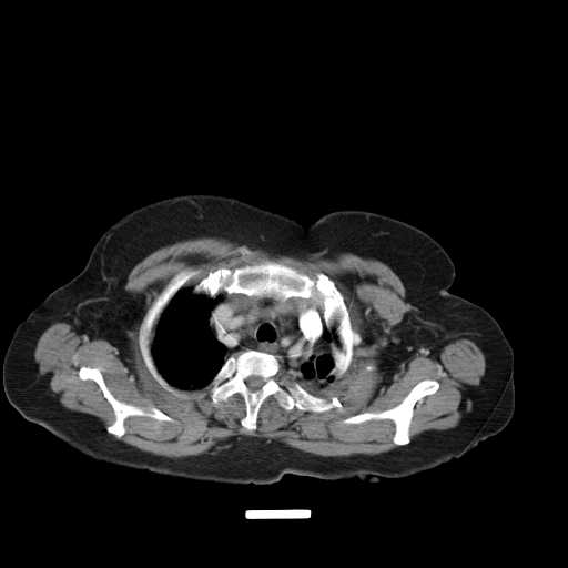 File:Carotid body tumor (Radiopaedia 21021-20948 A 27).jpg