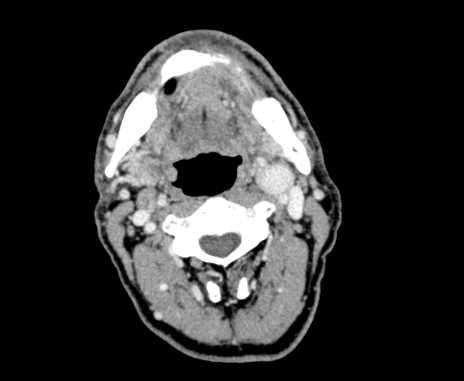 File:Carotid body tumor (Radiopaedia 61750-69757 Axial Post contrast 39).jpg