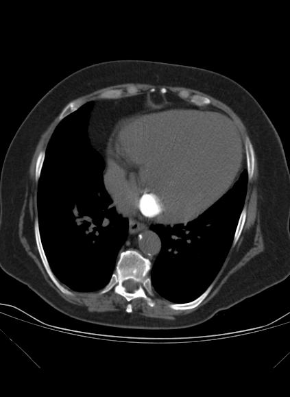 File:Caseous mitral annular calcification (Radiopaedia 61219-69122 Axial non-contrast 14).jpg