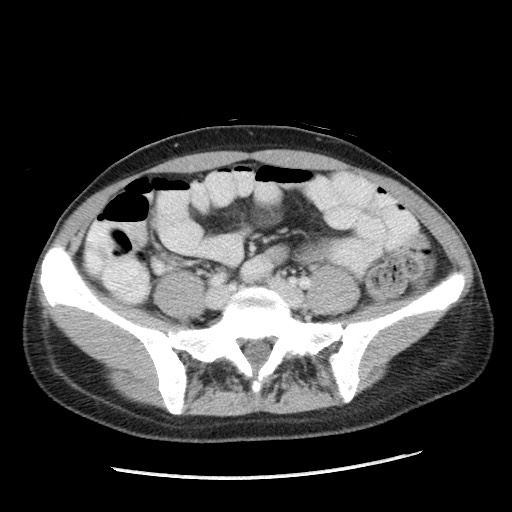 Castleman disease with fibrous pseudotumor in the abdomen (Radiopaedia 77296-89373 A 85).jpg