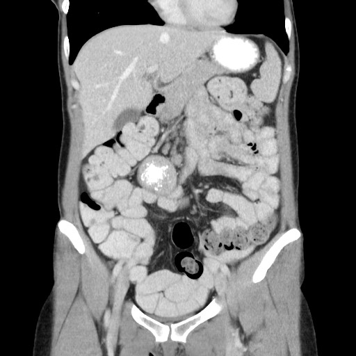 Castleman disease with fibrous pseudotumor in the abdomen (Radiopaedia 77296-89373 B 34).jpg
