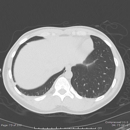 File:Catamenial pneumothorax (Radiopaedia 54382-60600 Axial non-contrast 75).jpg