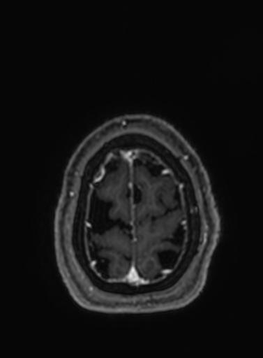 Cavernous hemangioma of the cerebellar falx (Radiopaedia 73025-83724 Axial T1 C+ 39).jpg