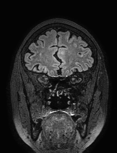 Cavernous hemangioma of the cerebellar falx (Radiopaedia 73025-83724 Coronal FLAIR 83).jpg