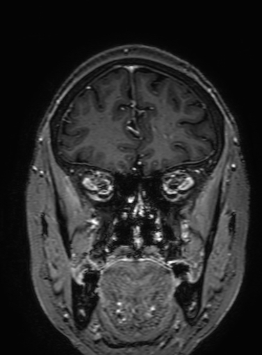 Cavernous hemangioma of the cerebellar falx (Radiopaedia 73025-83724 Coronal T1 C+ 96).jpg