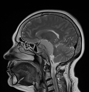 File:Cavernous sinus meningioma (Radiopaedia 63682-72367 Sagittal T2 9).jpg