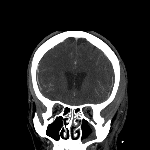File:Cavernous sinus thrombosis (Radiopaedia 10619-11078 D 7).jpg