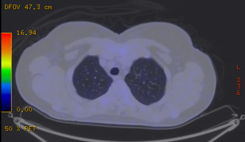 File:Cavitating lung mass - squamous cell carcinoma (Radiopaedia 48047-52853 A 22).png