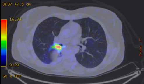 File:Cavitating lung mass - squamous cell carcinoma (Radiopaedia 48047-52853 A 46).png