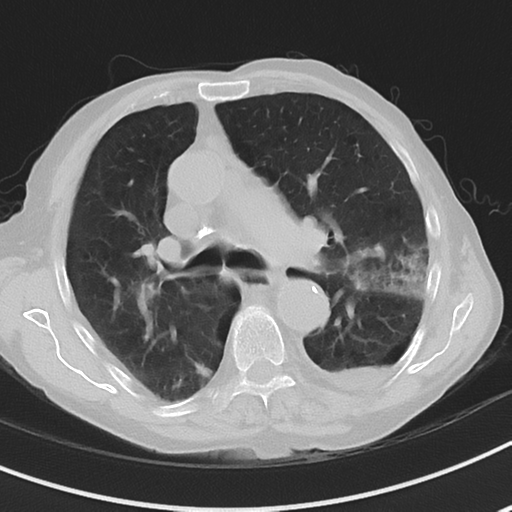 Cavitating pneumonia - lingular segments (Radiopaedia 34386-35678 Axial lung window 26).png