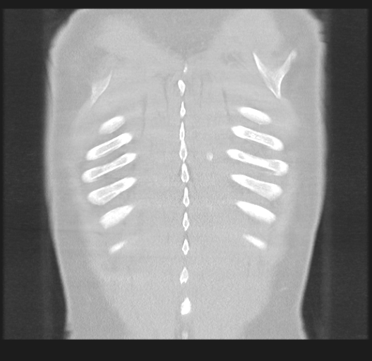 Cavitating pneumonia complicated by pneumothorax (Radiopaedia 48149-52994 Coronal lung window 53).png